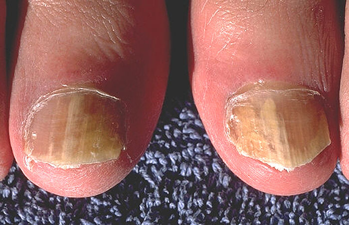 Tipos de enfermedades de las uñas  Tu canal de salud